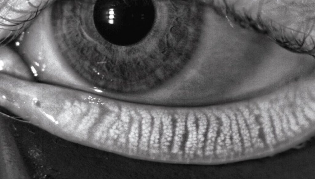 Black and white close-up of an eye; a pulled-down lower eyelid reveals prominent glands and tear film.