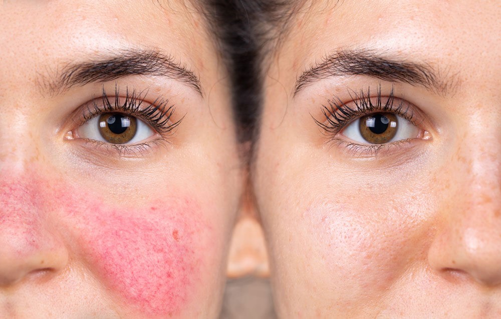 Before and after close-up of face showing rosacea (left) and clear skin (right).