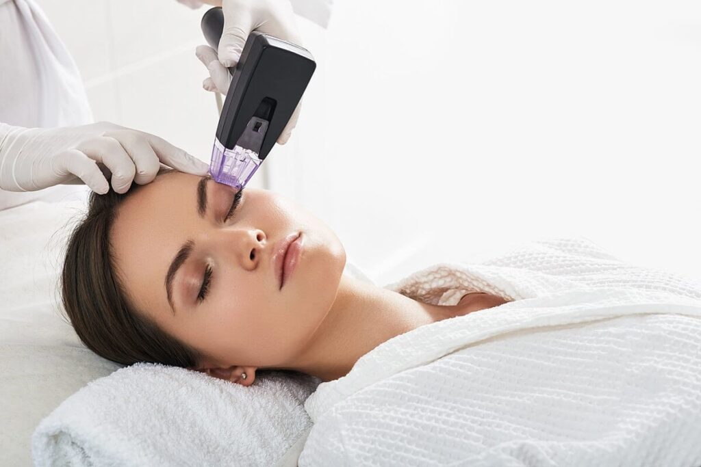 Woman receiving microneedling facial treatment in a bright spa setting.