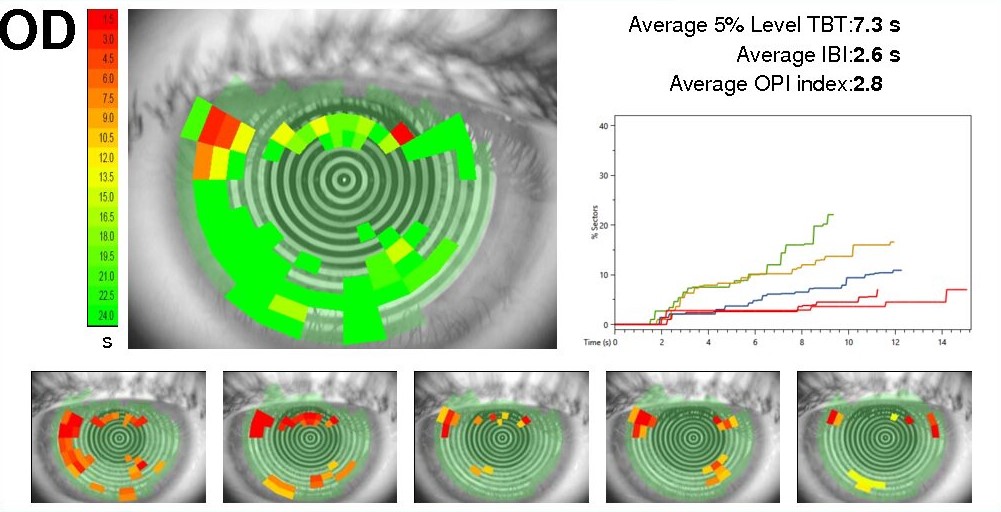 Medical eye scans with color-coded tear film stability maps, progression, and diagnostic charts.