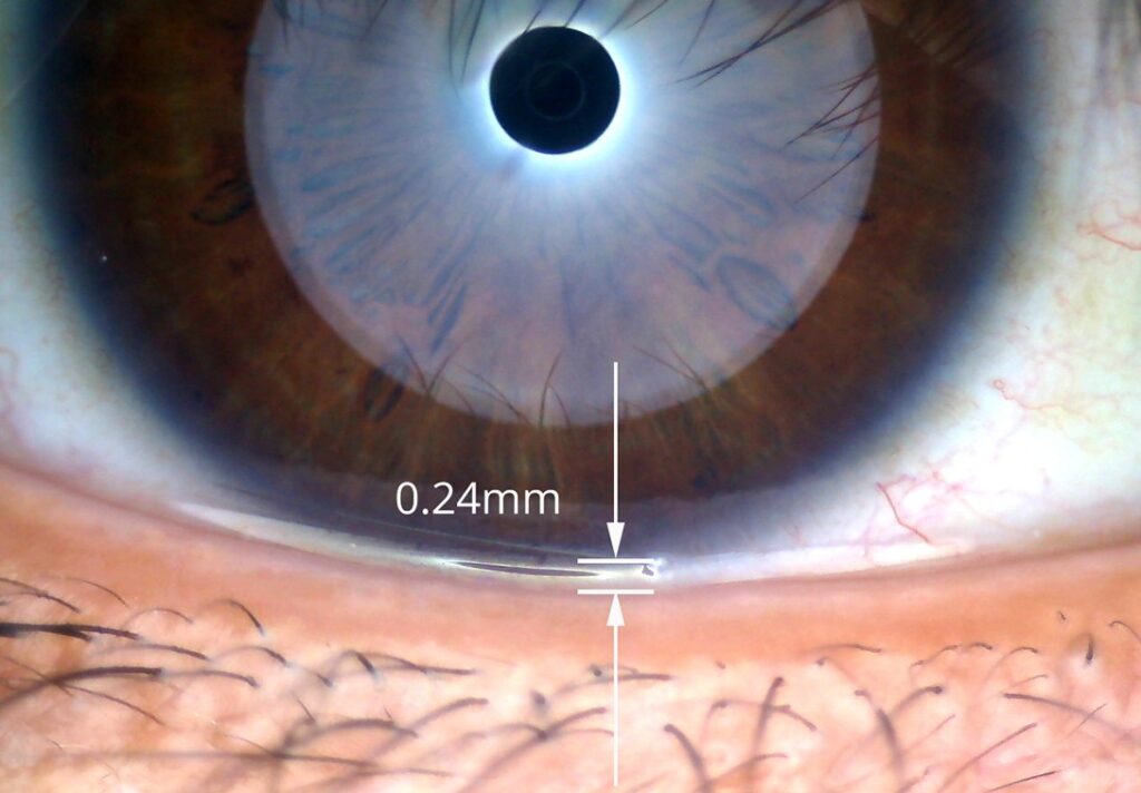 Close-up of an eye showing a tiny 0.24mm transparent object on the lower cornea.