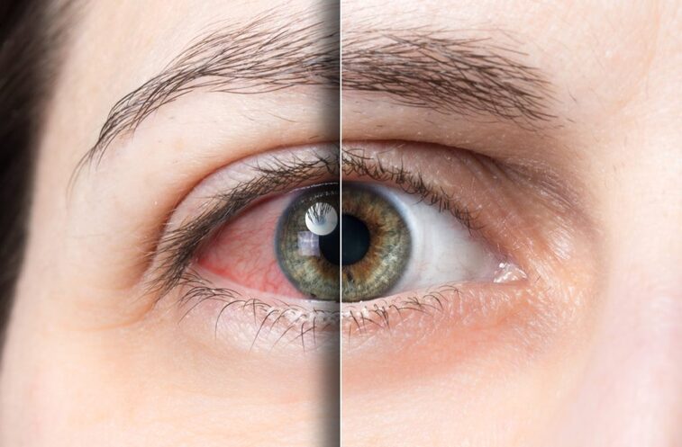 Close-up of one eye, half bloodshot and irritated, half clear and healthy.