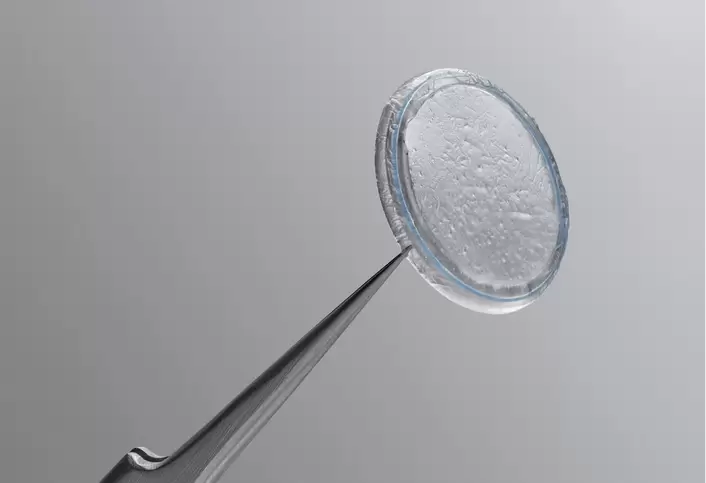 Close-up of a Prokera biologic corneal bandage held by medical forceps for advanced dry eye and corneal healing treatment.