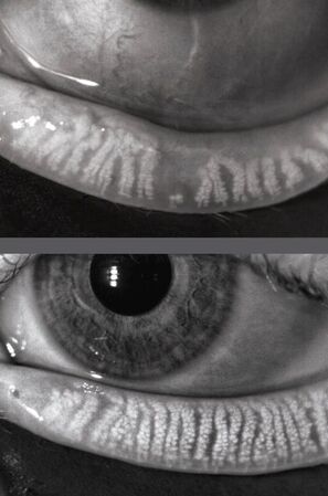 Meibomian Gland Dysfunction: The Hidden Cause of Dry Eye Syndrome and How Spectacle Is Changing the Way We Treat It
